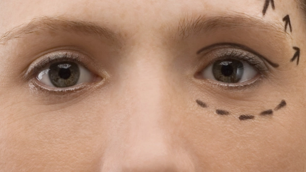 La blefaroplastia es una de las cirugías más recurrentes entre hombres y mujeres que buscan lucir menos cansados.